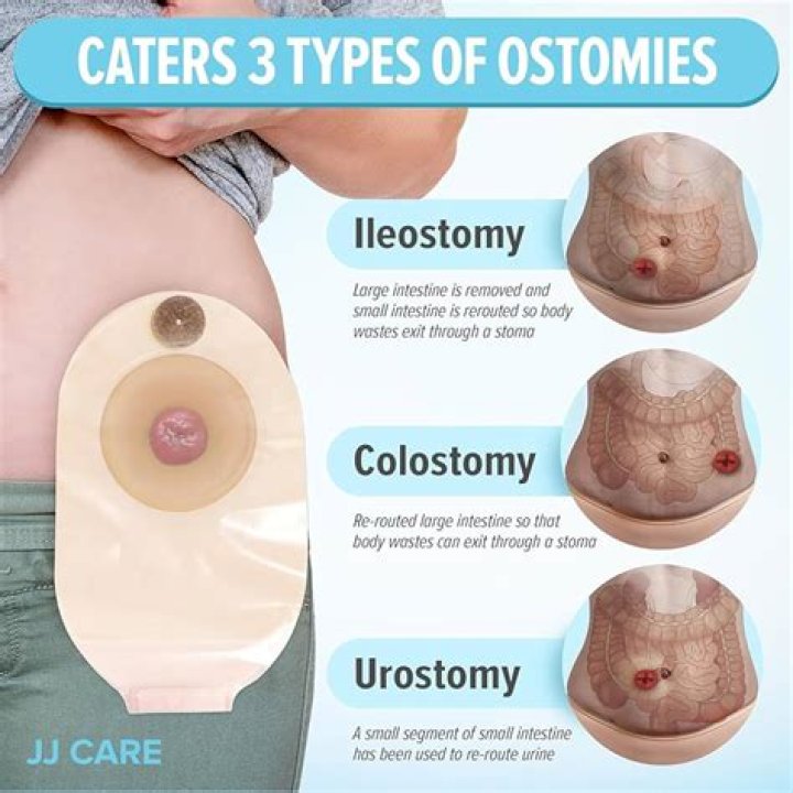 Are colostomy bags permanent?