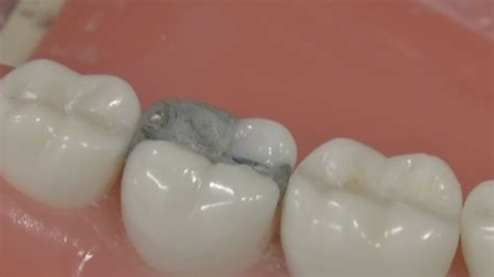 Are composite fillings toxic?