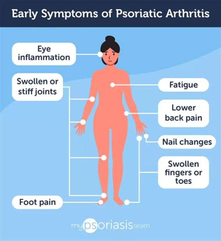 Are fibromyalgia and psoriatic arthritis related?