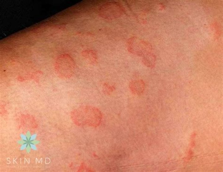 Are fungal infections itchy?