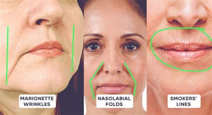 Are marionette lines genetic?