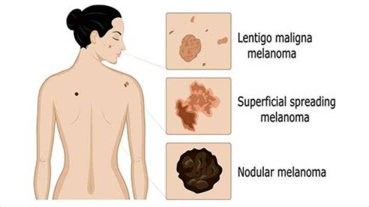 Are nodular melanomas hard or soft?