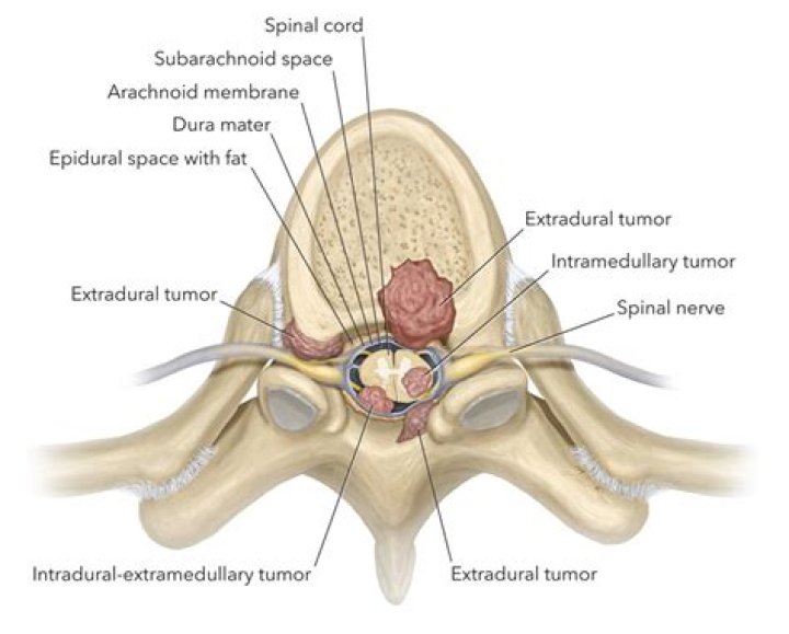 Are spinal tumors tender to touch?