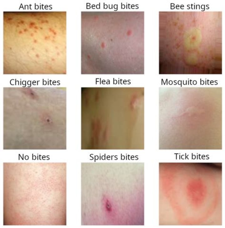 Are there any rashes that look like bug bites?