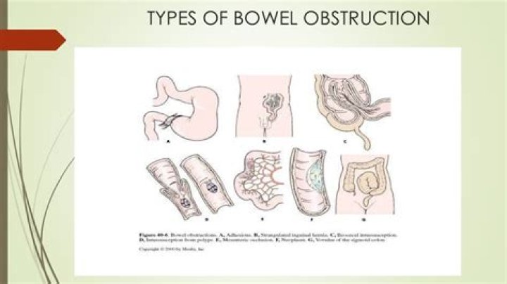 Can a bowel obstruction clear on its own?