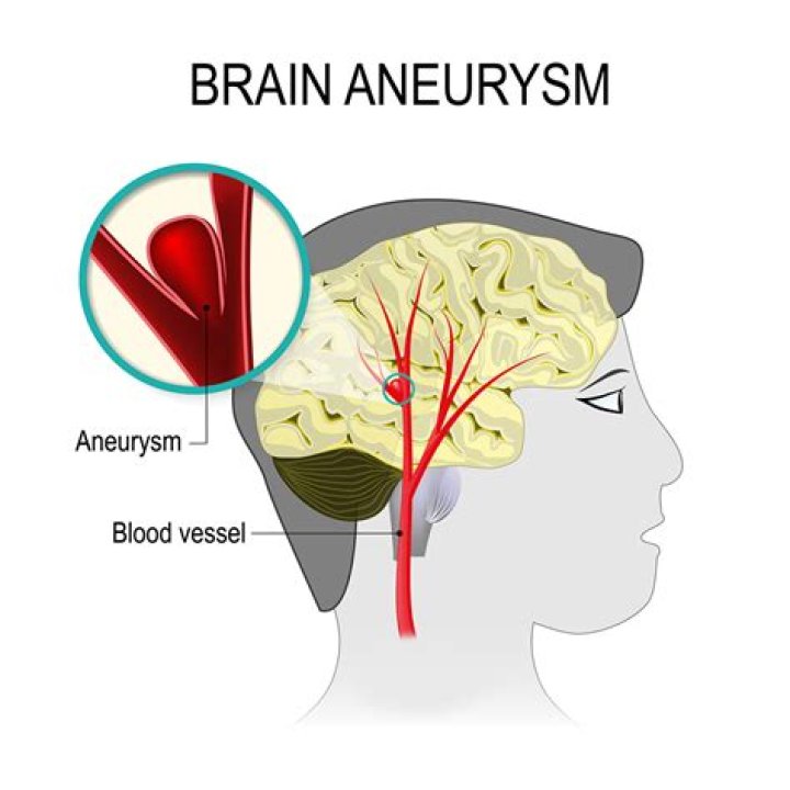 Can a brain aneurysm affect your mood?