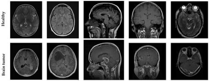 Can a brain MRI show depression?