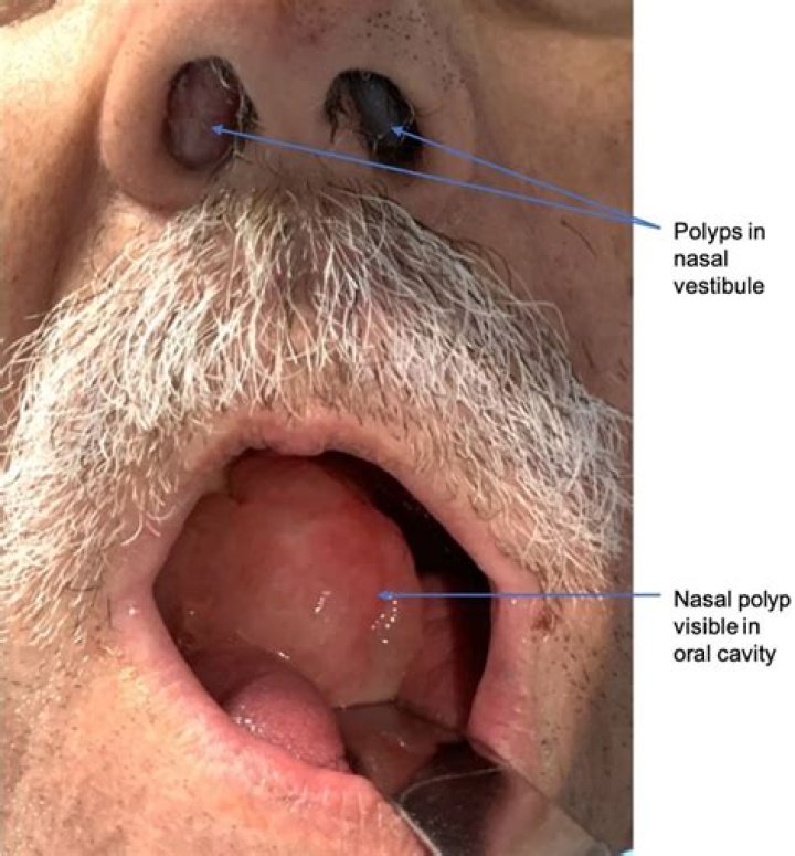 Can a large polyp be benign?