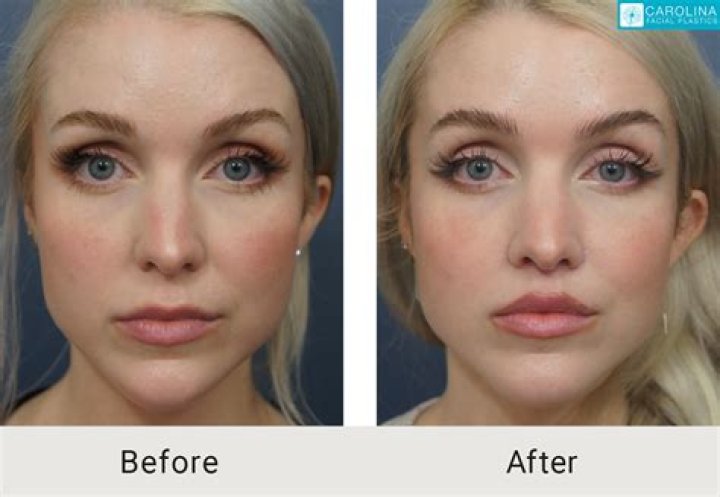 Can a lip lift Change your nose?