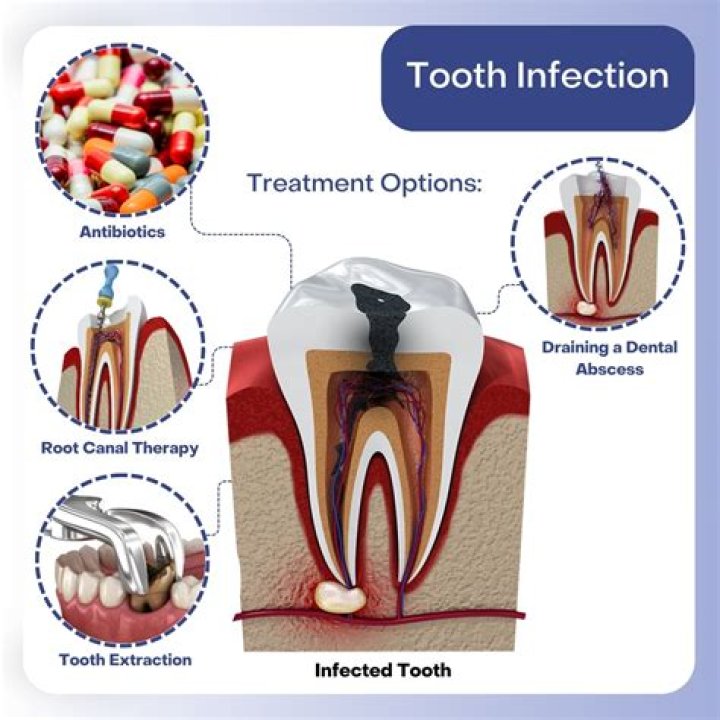Can an infected wisdom tooth make you feel unwell?