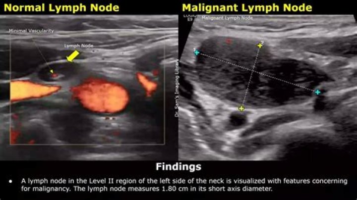 Can an ultrasound tell if a lymph node is cancerous?