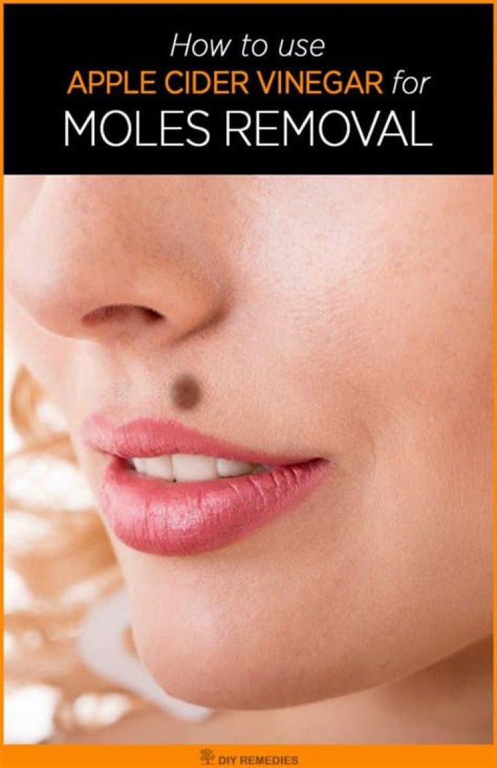 Can Apple cider vinegar remove moles?