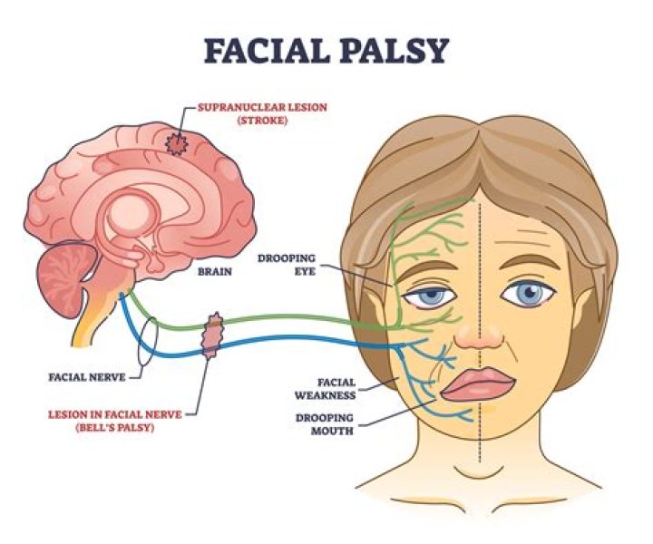 Can Bell's Palsy turn into something else?