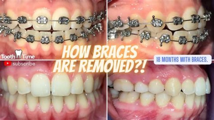 Can braces remove in 6 months?