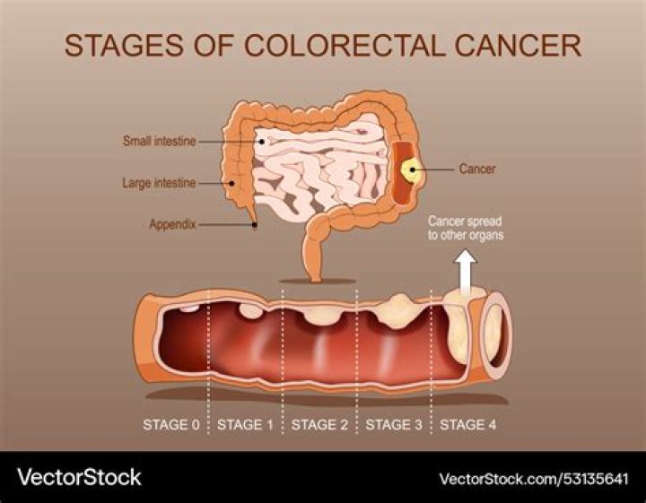 Can colon cancer grow in 4 years?