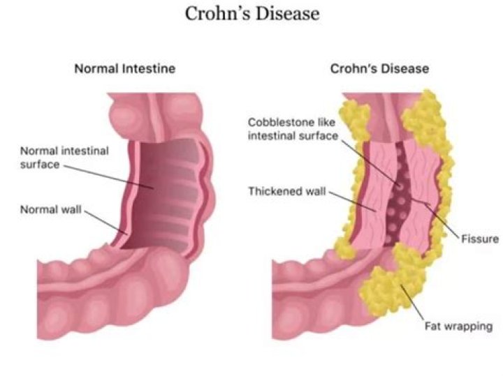 Can Crohns be mistaken for IBS?