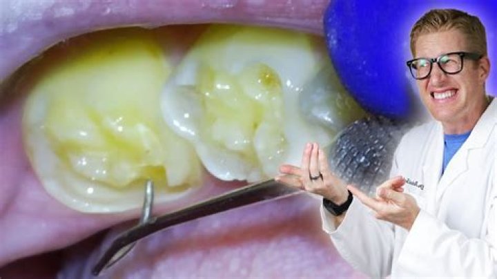 Can dentist Add enamel to teeth?
