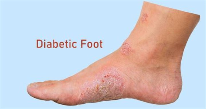 Can diabetes cause itchy feet?