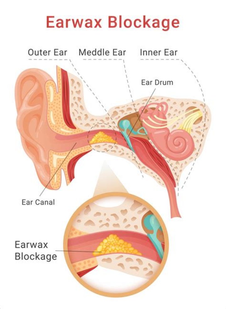 Can earwax cause dementia?