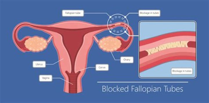 Can fibroids cause blocked fallopian tubes?