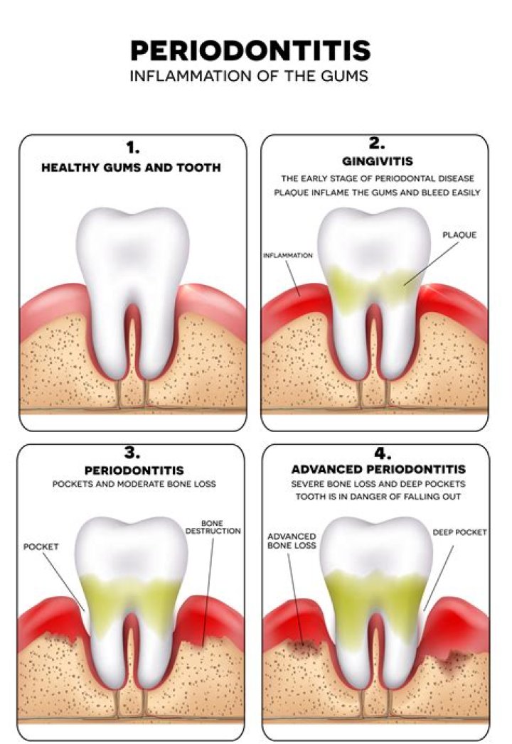 Can gums grow back after periodontal disease?