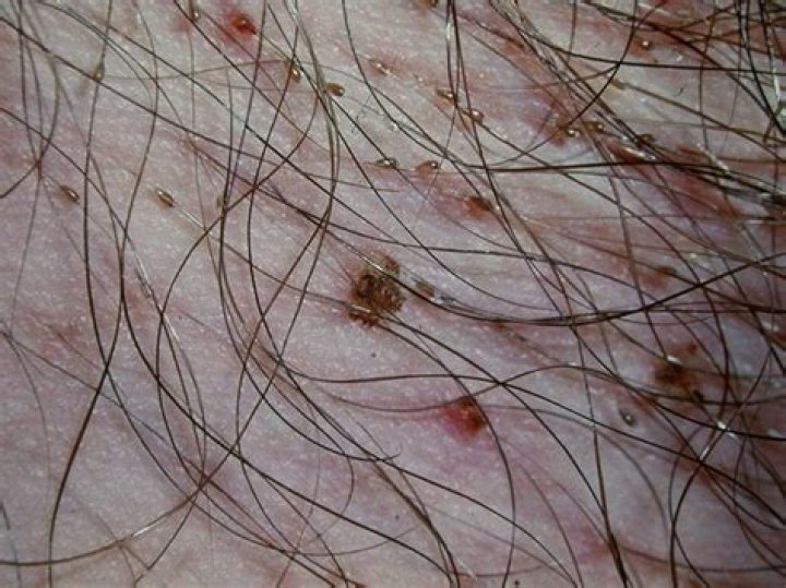 Can head lice live in pubic hair?