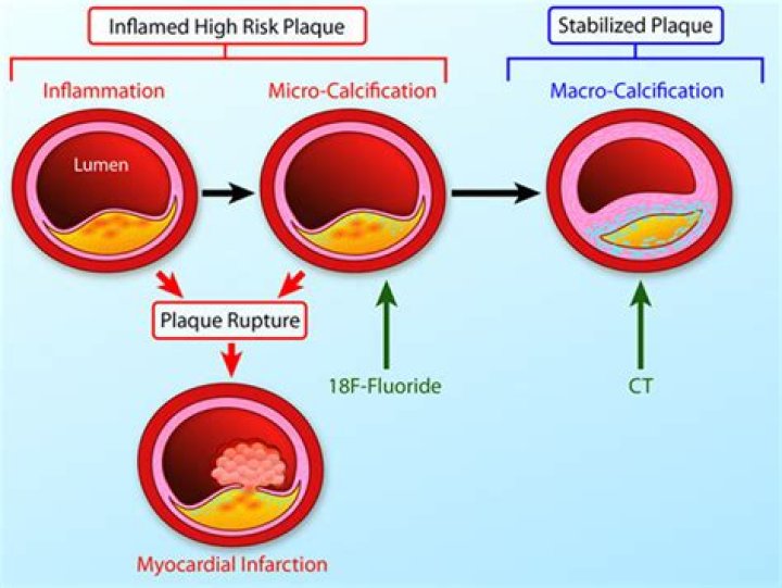 Can heart plaque reversed?