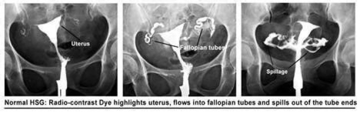 Can HSG damage eggs?