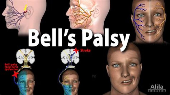 Can I get disability for Bell's palsy?