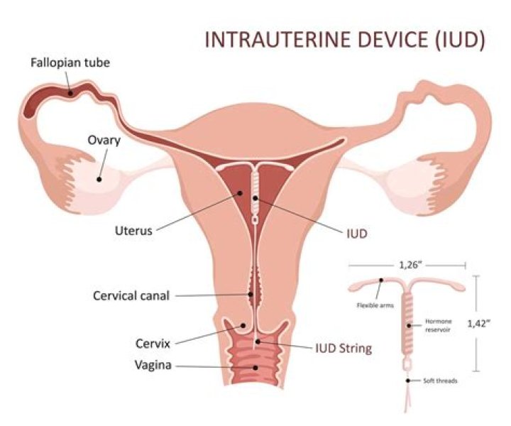 Can I run after IUD insertion?