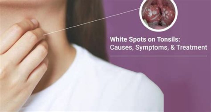 Can I scrape off white spots on tonsils?