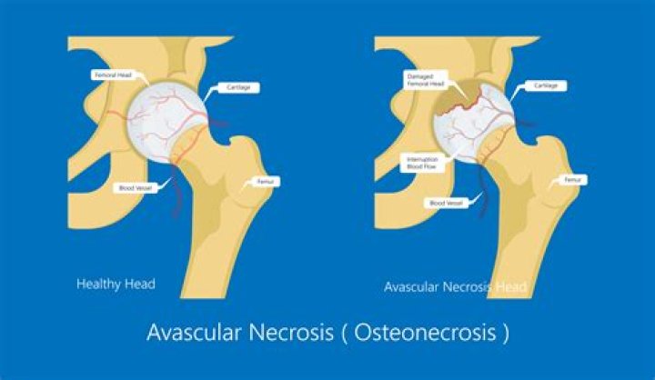 Can ibuprofen cause avascular necrosis?