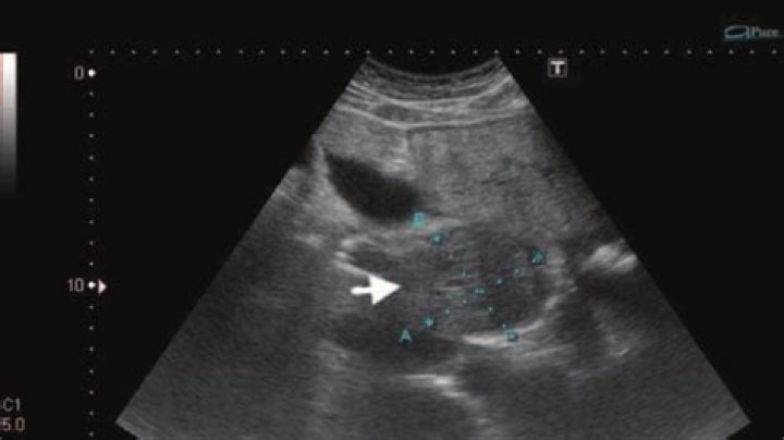 Can liver spots turn cancerous?