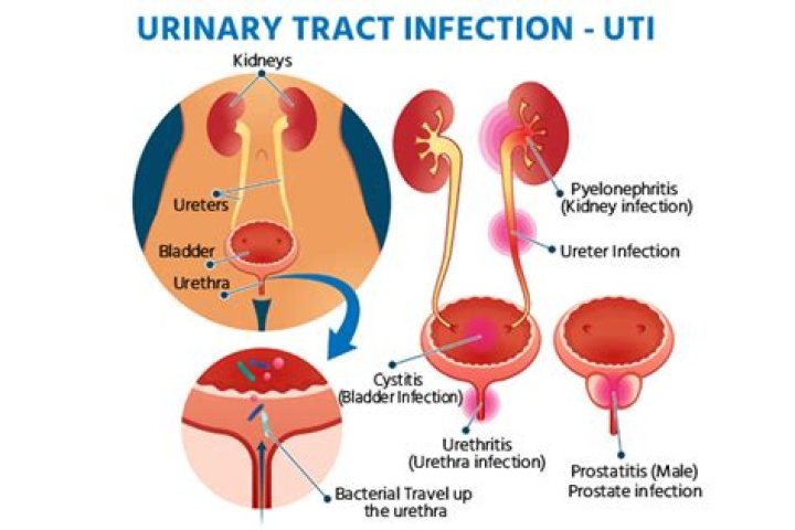 Can poop come out of urinary tract?