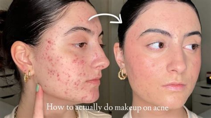 Can someone be pretty with acne?