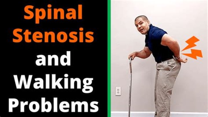 Can spinal stenosis cause walking problems?