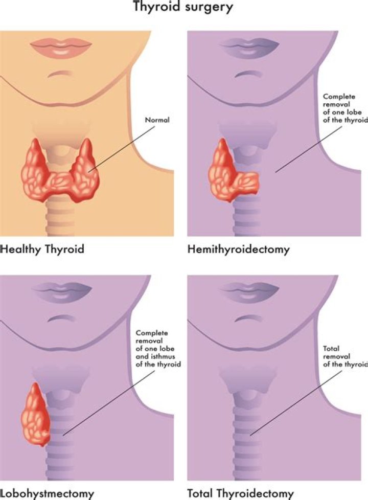 Can thyroid removal change your personality?