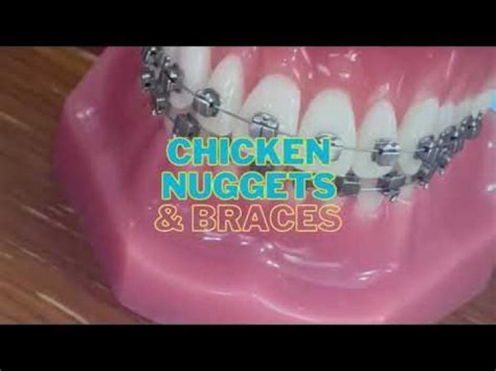 Can u eat chicken nuggets with braces?