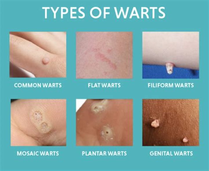 Can warts be popped?