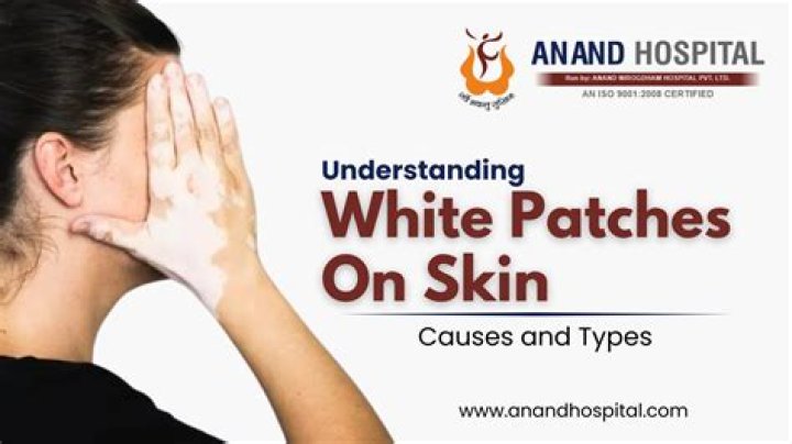 Can white patches on skin be cured?