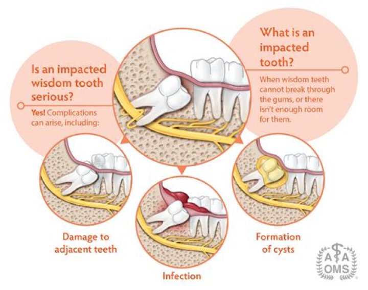 Can wisdom teeth rot in your mouth?