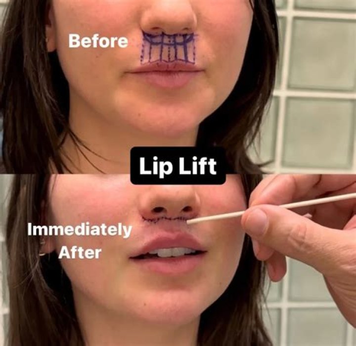 Can you close your mouth after lip lift?