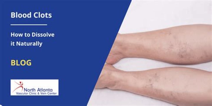 Can you dissolve a blood clot on your own?