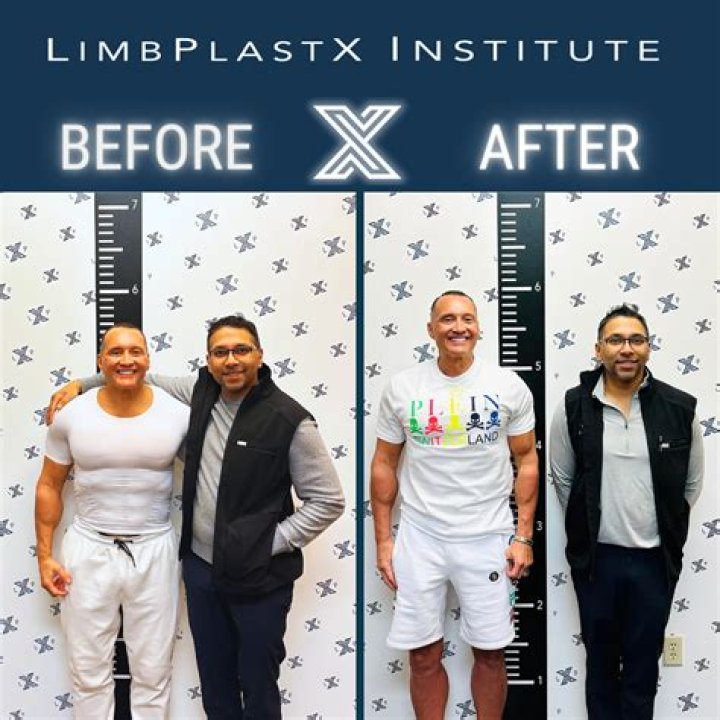 Can you lift weights after limb lengthening surgery?