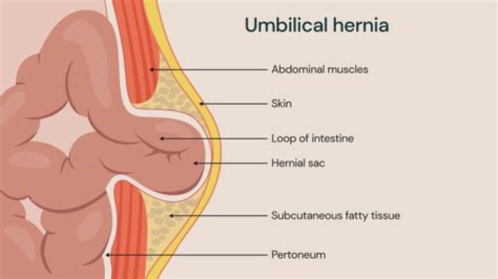 Can you push a Parastomal hernia back in?