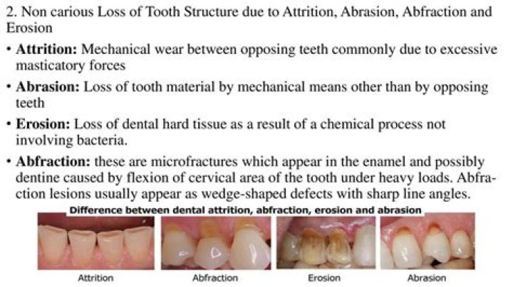 Can you reverse tooth abrasion?