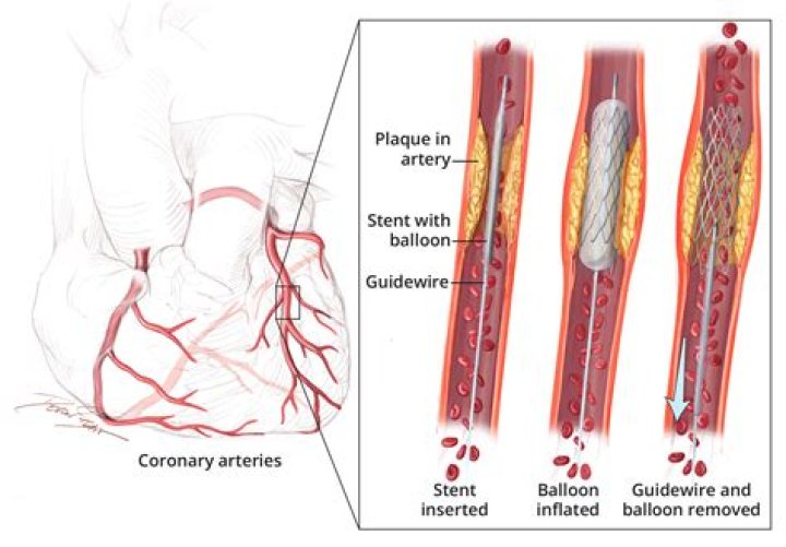 Can you Stent a 100% blocked artery?