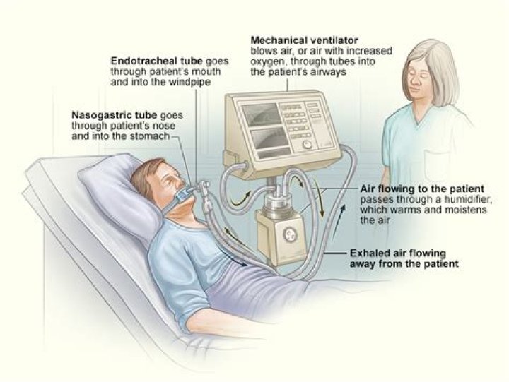 Can you survive after being on a ventilator?