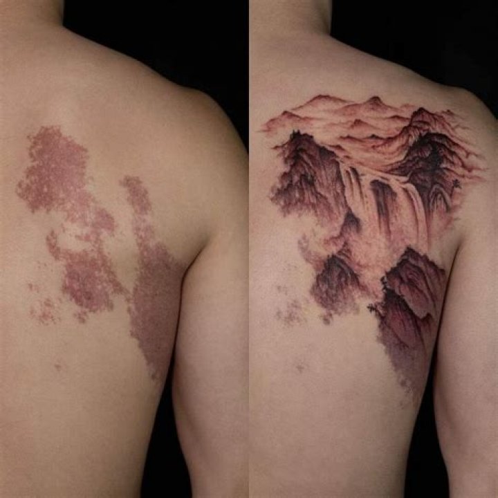 Can you tattoo over birthmark?