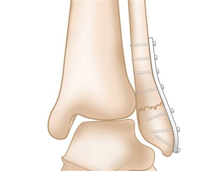 Do all ankle fractures need surgery?